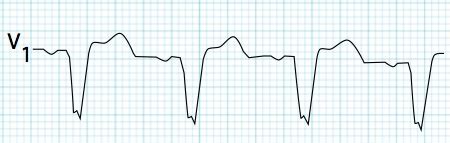 Left Bundle Branch Block - ECG book