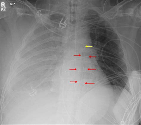 Intra-Aortic Balloon Pump