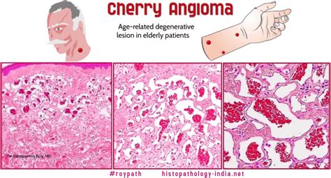 Pathology of Cherry Angioma (senile angioma, Campbell de Morgan spots) - Dr Sampurna Roy MD