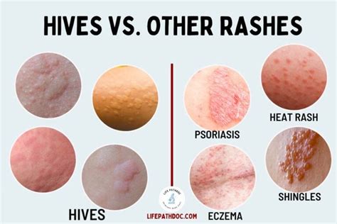 Hives (Urticaria) vs. Rash: Pictures and Differences