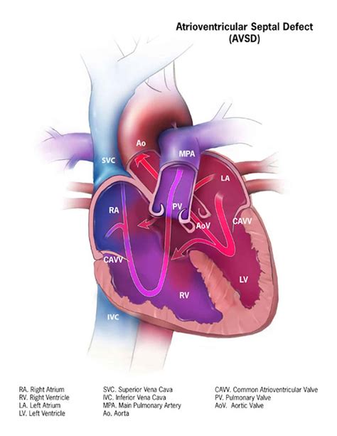 Atrioventricular Septal Defects (AVSD) - TeachMePaediatrics