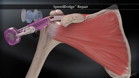Arthrex - SpeedBridge™ Double-Row Technique
