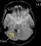 Chronic Trauma with Diffuse Axonal Injury-MRI - Sumer's Radiology Blog