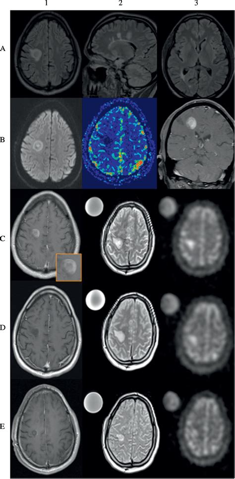 23Na MRI reveals persistent sodium accumulation in tumefactive MS ...