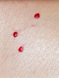 Cherry angioma tiny pinpoint red dots on skin - koguide