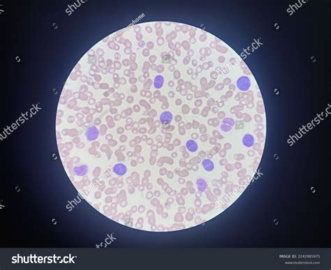 Blood Smear Taken Microscope Show Promyelocyte Stock Photo 2242985975 ...