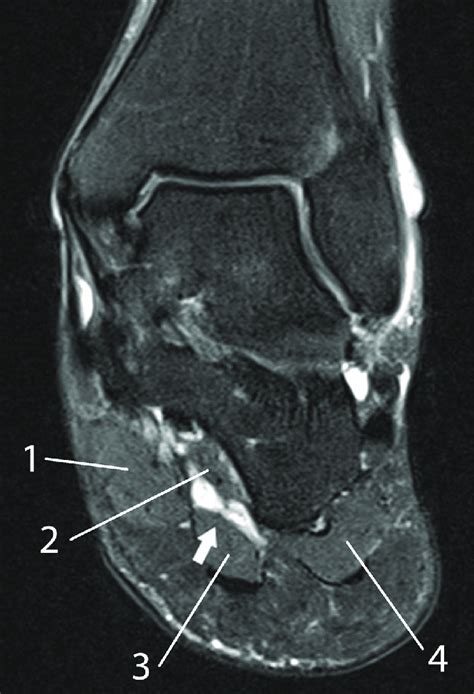 MRI of the left foot in a normal patient for comparison. Coronal... | Download Scientific Diagram