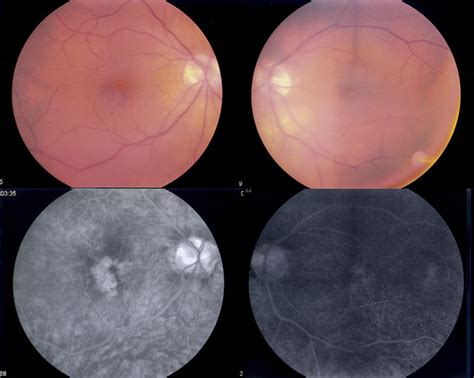 Figure 1 from Bilateral cystoid macular edema after phacoemulsification in post-laser in situ ...