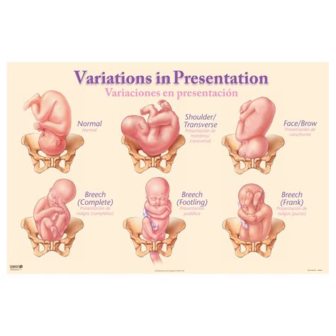 Variations in Presentation Chart | Childbirth Graphics