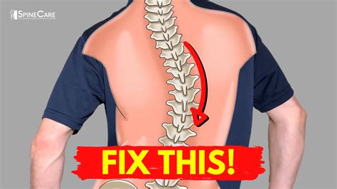 How to Relieve Your Scoliosis Back Pain in 30 SECONDS | SpineCare