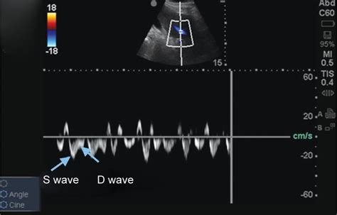 Combination of Inferior Vena Cava Diameter, Hepatic Venous Flow, and Portal Vein Pulsatility ...