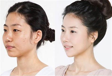 Korean Flat Nose Surgery Before After (2) » Rhinoplasty: Cost, Pics ...