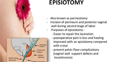 Episiotomy