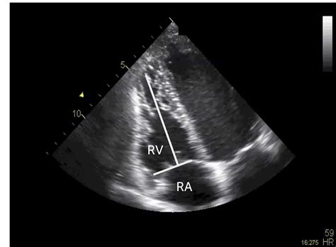 3.3.3 Visual assessment of right ventricular function | 123sonography