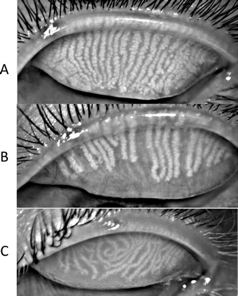 Finally a cure for dry eye? - Eyestyle