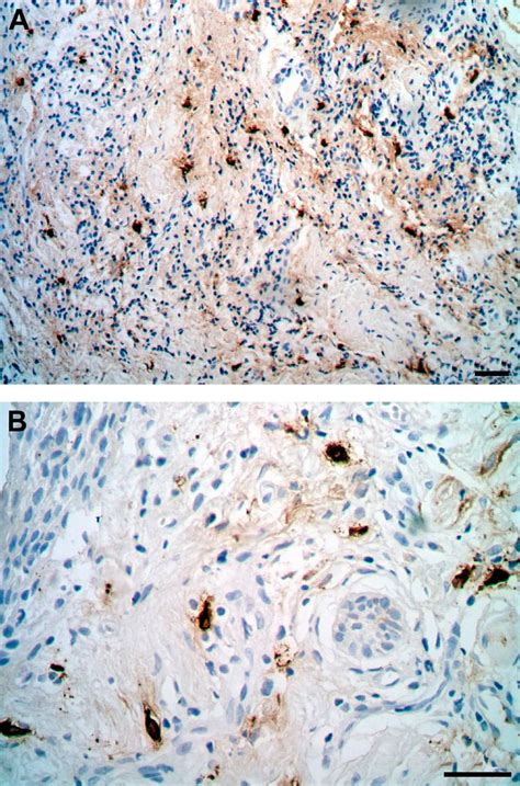 Immunohistochemistry with mast cell tryptase antibody showing mast cell ...