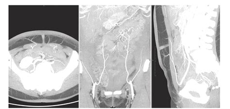 The Breast Cancer Reconstruction Blog: Do you need a CT angiogram before DIEP flap breast ...