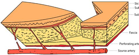 Schematic diagram of the V-Y advancement flap. The subcutaneous flap ...