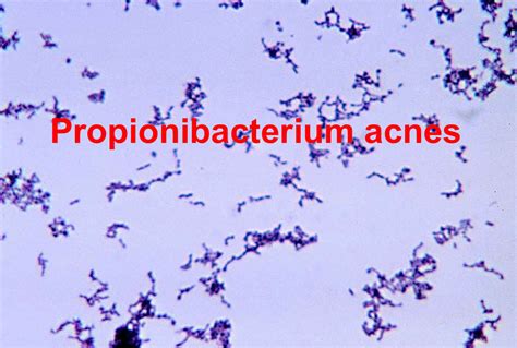 Propionibacterium acnes, infection, symptoms & treatment