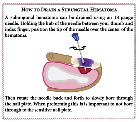 Subungual Hematoma Drainage