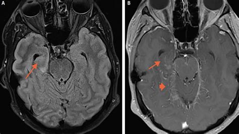 Temporal Lobe Lesions - The Neurology Hub