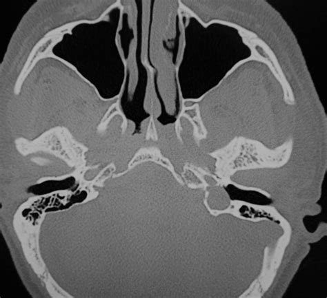 Dehiscent jugular bulb : CT - Sumer's Radiology Blog