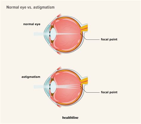 Can Astigmatism Be Fixed with Glasses?