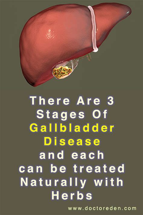 Stages Of Gallbladder Disease And How To Avoid It – Remove Gallstones Without Surgery