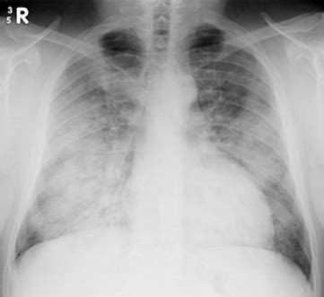 Acute Respiratory Distress Syndrome (ARDS) - Physiopedia