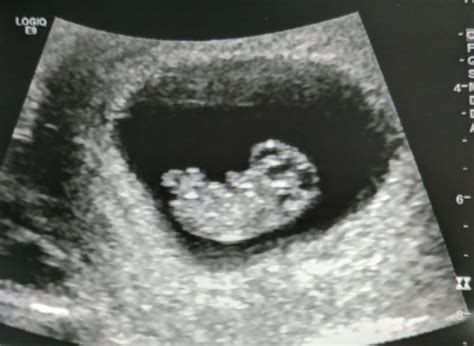 9 week (first) ultrasound | BabyCenter