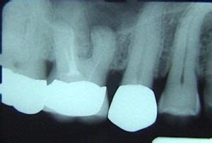 Tooth Pulp Infection - III.3 – The Center for Dental Education