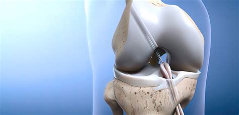 Knee Ligament Surgery – Trinay Orthopedic