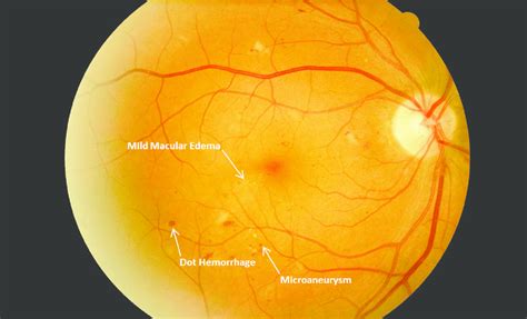 Moderate non-proliferative diabetic retinopathy with mild diabetic... | Download Scientific Diagram