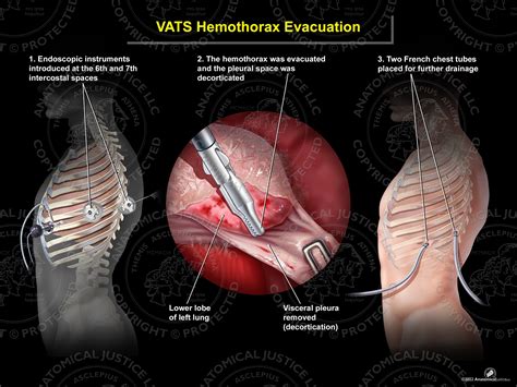 VATS Hemothorax Evacuation