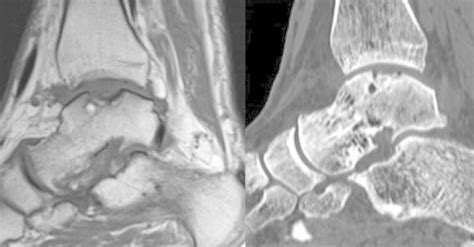 Osteochondral lesion on the talar dome: MRI compared with CT image ...