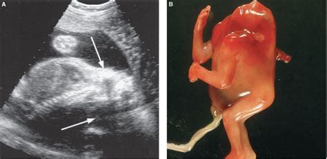 Neural Tube Defects | Radiology Key