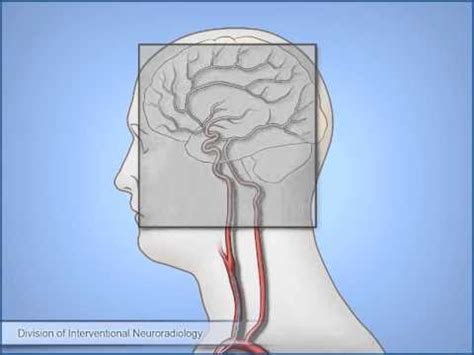 ¿Qué es una angiografía cerebral? - Salud - 2022