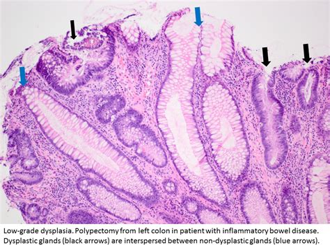 Pathology Outlines - Dysplasia