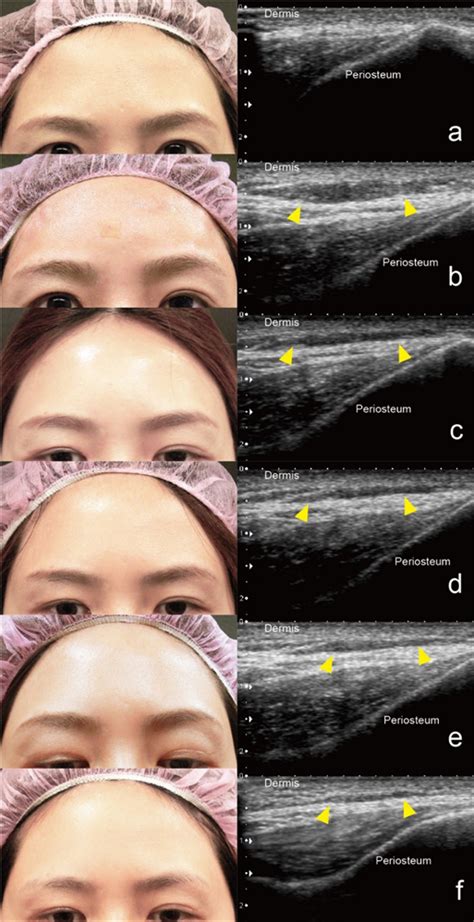 CHAP-Hyaluronic Acid (CHAP-HA) Filler as an Optimal Candidate for ...