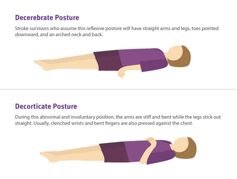 Decorticate Posturing Indicates Damage To What Part Of The Brain | Bruin Blog