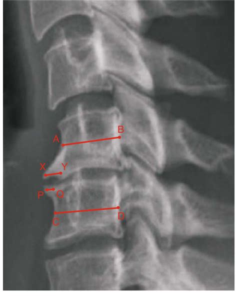 Large Anterior Osteophytes