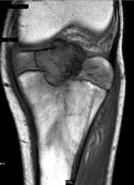 Chondroblastoma-MRI - Sumer's Radiology Blog