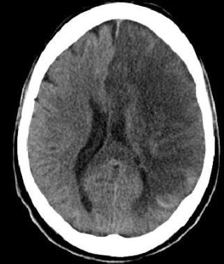 Stroke Imaging: Practice Essentials, Computed Tomography, Magnetic ...