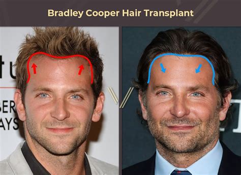 12+ Celebrity Hair Transplant Scar - RubanaTyrese