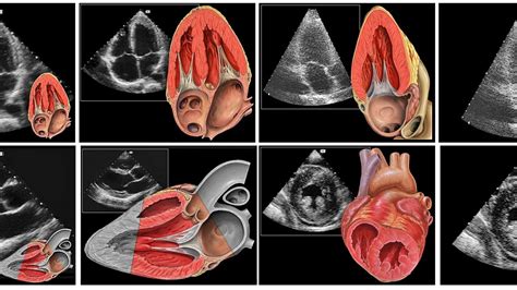 TTE: Transthoracic Echocardiogram - SONOSIF - by SIFSOF, California