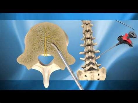 Pin on Spinal stenosis CORE and MASSAGES