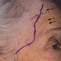 Temporal Artery Biopsy | Ento Key