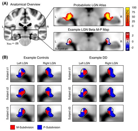 Definition of M/P-LGN in control and DD participants. (A) Left ...