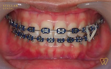 Braces Colors: Top Picks For 2023 - Stellar Dental