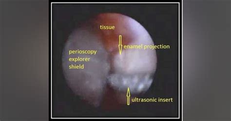 Enamel pearl case studies | Dentistry IQ